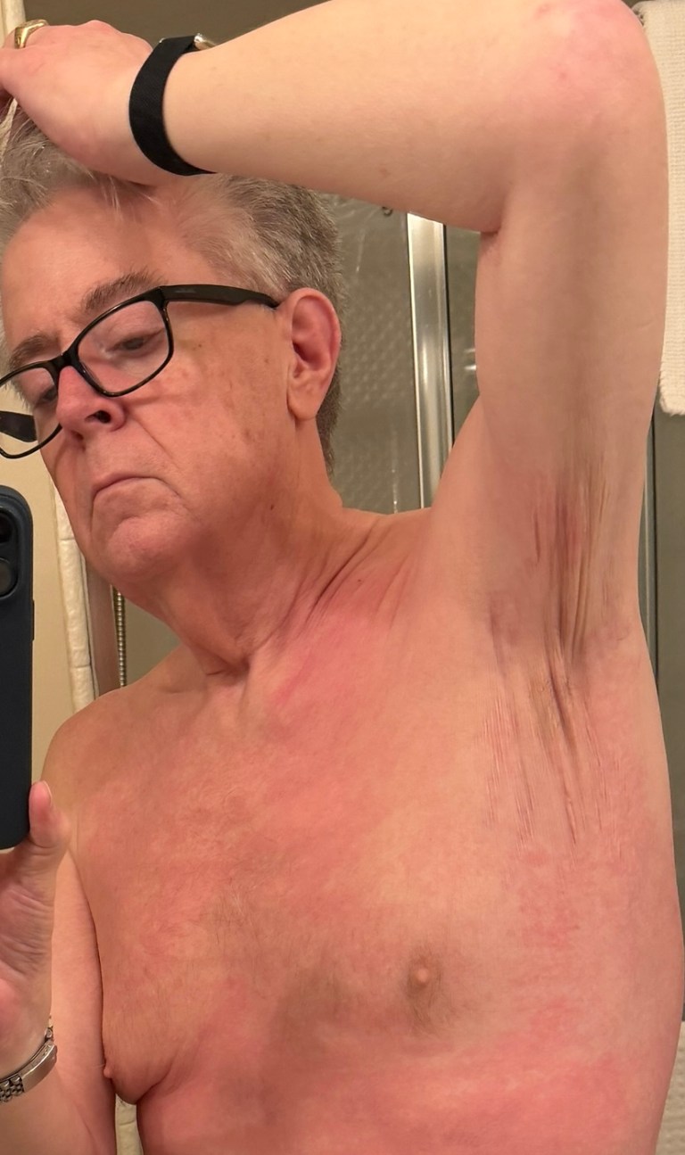 Skin changes before diagnosis, January 23, 2026