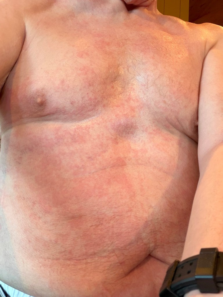 Skin changes before diagnosis, March 5, 2026