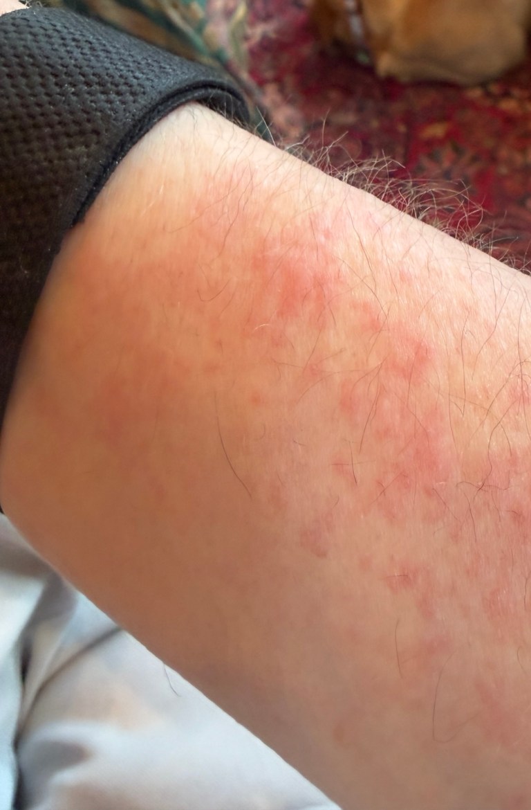 Skin changes before diagnosis, May 19, 2026
