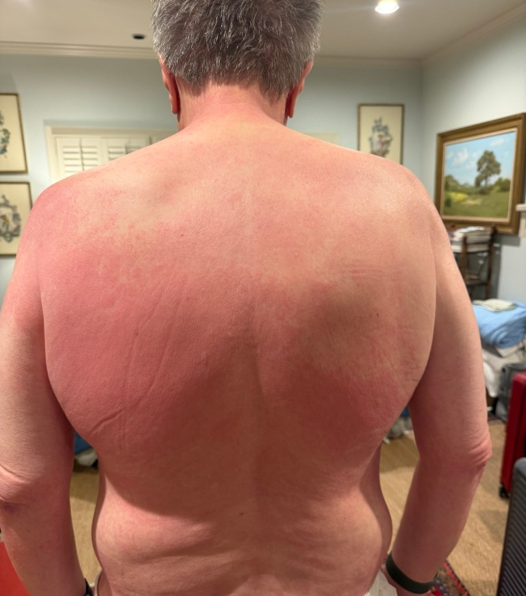 Back view of skin changes before diagnosis, July 9, 2026