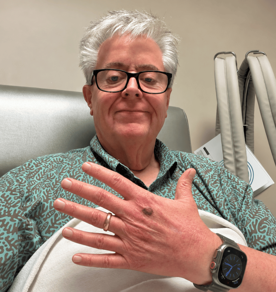 William Reed during MOGA infusion number six, holding up a humorous edited hand with six fingers.